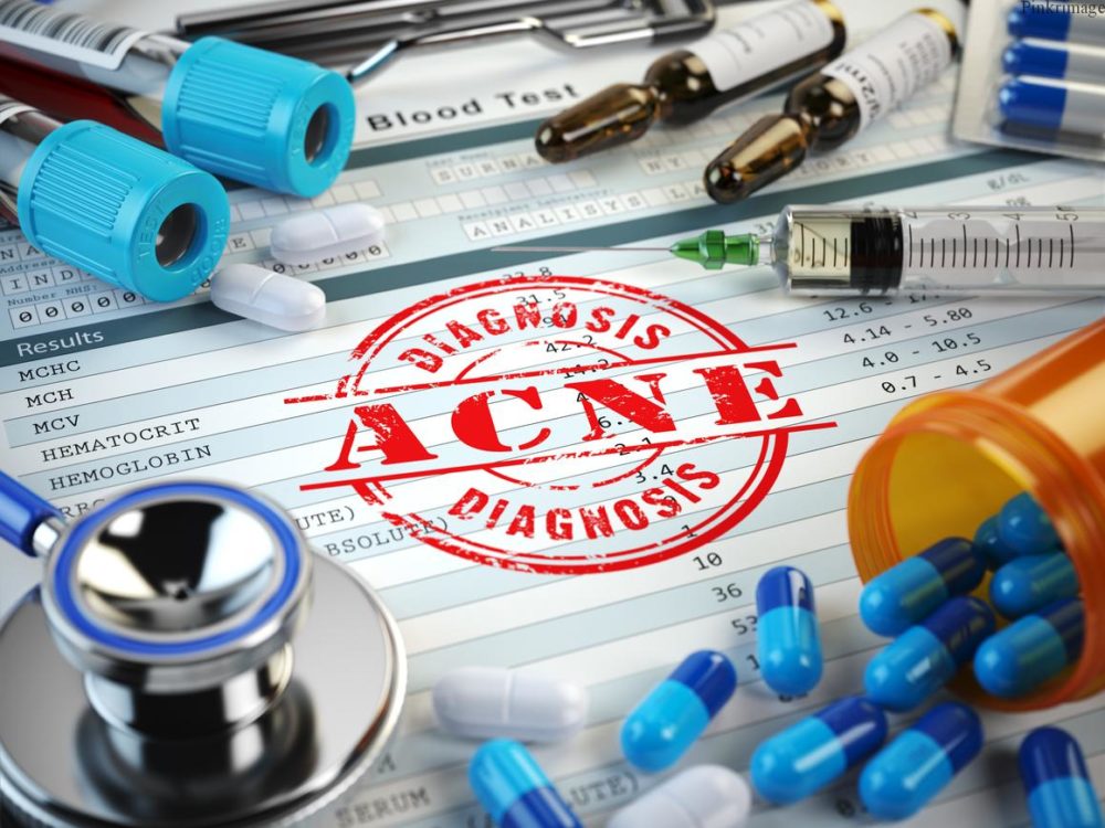 Read more about the article Major Causes of Acne in Adults + How to Treat Them