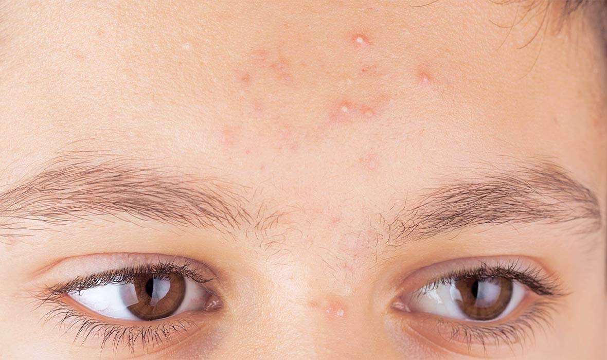 Read more about the article Whiteheads: What Causes Whiteheads and How to Prevent Them